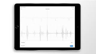 Atrial Fibrillation Combined Heart Sound PCG amp ECG Example  EkoCLINIC App [upl. by Dolorita]