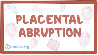 Placental abruption  causes symptoms diagnosis treatment pathology [upl. by Gausman]