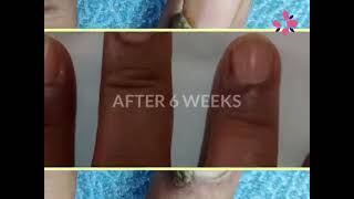 REMOVAL OF A PERIUNGUAL WART USING ELECTROFULGURATION TECHNIQUE [upl. by Salena251]