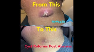 Cyst reforms months after Incision amp Drainage of large neck abscess Removal and dissection today [upl. by Ilrac12]