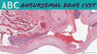 Aneurysmal Bone Cyst ABC 5Minute Pathology Pearls [upl. by Alimac]