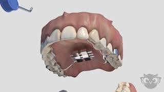 Palatal Expander [upl. by Noterb789]