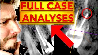 Advanced Dental Radiographs Interpretation CARIES amp Radiolucent LESIONS  OPG Xray 3D CBCT reading [upl. by Lyrradal702]