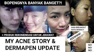 MY ACNE STORY amp DERMAPEN UPDATE  Cara aku hilangkan jerawat beruntusan bopeng  rekomendasi produk [upl. by Zigmund]