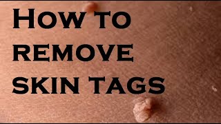 How to remove skin tags [upl. by Derte]