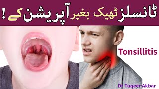 Tonsillitis  Tonsillitis Cure With out Surgery  Chronic Tonsillitis  AILANTHUS  By Dr Tuqeer [upl. by Ramu972]