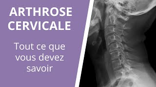 Tout ce que vous devez savoir sur larthrose cervicale  causes symptômes et traitements [upl. by Leatri698]