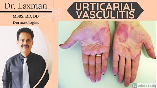 Urticarial Vasculitis  Vasculitis  Causes amp Symptoms amp Treatment Vasculitis Allergy Dermatology [upl. by Sebastian911]