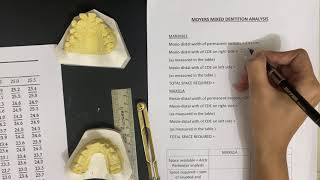 Moyers Mixed Dentition Analysis [upl. by Aubrey380]