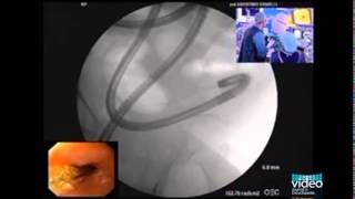 Enteroscopic Balloon Dilation of Multiple Ileal Strictures in Suspected Crohns Disease [upl. by Jeffy]