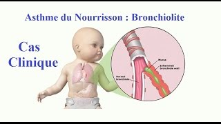 Bronchiolite Asthme du Nourrisson Cas Clinique [upl. by Enairb118]