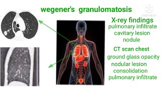 Wegeners granulomatosissymptomdiagnosis amp management [upl. by Odnavres]