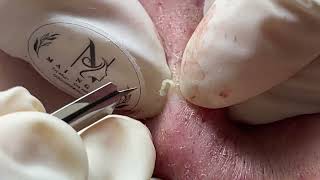 ACNE UNDER THE SKIN  Acne Treatment Mai Ngoc [upl. by Beckman]