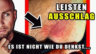 Leisten Hautausschlag  Kein Hautpilz Was ihn triggert amp beeinflusst  neutrophile Dermatose [upl. by Thrasher]