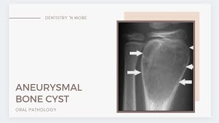 ANEURYSMAL BONE CYST [upl. by Blainey]