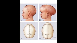 Craniosynostosis II የህፃናት የጭንቅላት አጥንት ቀድሞ መዘጋት II Dr Temesgen Shume [upl. by Nit]