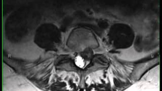 Lumbar Spinal Schwannoma [upl. by Nidorf664]