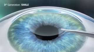 Relex SMILE versus LASIK versus PRK en LASEK [upl. by Yebot925]