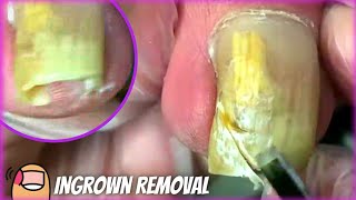 Cutting this Long Ingrown Toenail by Podiatrist  Treatment amp How to remove  get rid of it PEDICURE [upl. by Nohs]