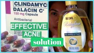 DALACIN C FOR ACNE DARK SPOTS  HIGHLY EFFECTIVE ACNEPIMPLE SOLUTION  Helmz Jordan [upl. by Omer629]