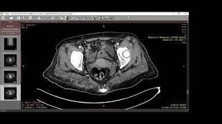 Emphysematous pyelonephritis [upl. by Ahsekyw439]