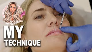 Watch this full treatment of RUSSIAN LIPS  Dermal filler  Before amp after [upl. by Honeyman]