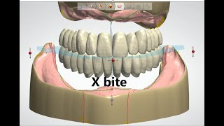 Crossbite setup in 3Shape [upl. by Ronny]