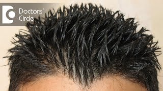 How to treat Androgenic Alopecia not responding to minoxidil amp finasteride  Dr Aruna Prasad [upl. by Neerac]