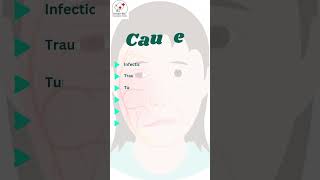 Know About Facial Nerve Palsy nerveloss facialnerveloss bellspalsy ghoshentfoundation ent [upl. by Yroggerg]