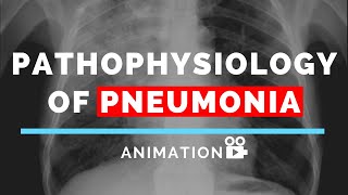 Pathophysiology of Pneumonia  Animation  Made Easy [upl. by Ennej]