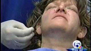 Acculift 30 minute Facelift  Dr Man Plastic surgery [upl. by Anyd339]