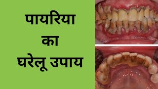 पायरिया का घरेलू उपाय home remedies for pyorrheapyorrhea treatment at homeपायरिया का ईलाज [upl. by Thorvald843]