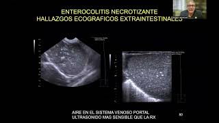 ULTRASONIDO Y DOPPLER EN LA ENTEROCOLITIS NECROTIZANTE DEL RNDR PEDRO UNSHELM [upl. by Nart131]