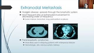 Systemic Treatment in Pediatric Hodgkin Lymphoma amp NHL Prof Rachna Seth [upl. by Allimac]