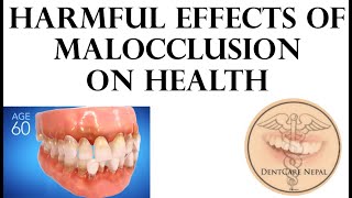 Harmful Effects of Malocclusion on Health [upl. by Flor13]