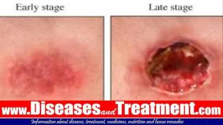 Pressure Ulcers  Bed Sores  Pressure Sores  Causes Symptoms Diagnosis Treatment Prevention [upl. by Calendra704]