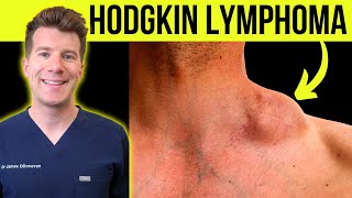 Doctor explains WARNING SYMPTOMS and SIGNS of HODGKINS LYMPHOMA CANCER [upl. by Nylednarb]