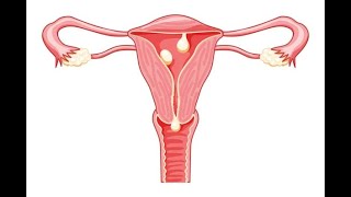 Uterine amp Endocervical Polyp Endometrial biopsy Dilatation amp Curettage Endometriosis Adenomyosis [upl. by Malony]