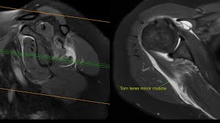 Teres Minor and Infraspinatus tear MRI [upl. by Esinehs]