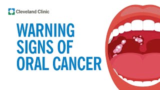 How to Screen Yourself for Oral Cancer [upl. by Papst]