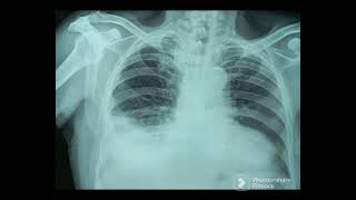 Hydropneumothorax Chest X Ray [upl. by Aiuhsoj340]