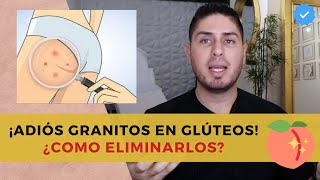 Te explico como deshacerte de los GRANITOS en los glúteos Foliculitis  DOCTOR LEMUS [upl. by Nor]