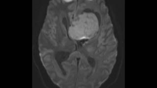 Anaplastic Ependymoma [upl. by Nimajaneb917]