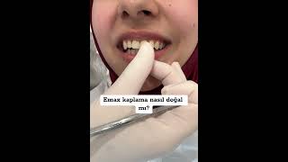 Lamine mi zirkon mu laminediş zirkonyumkaplama veneers zirkonia ciltbakımı [upl. by Peggy]