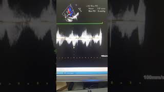 Case54 echocardiography  TOF with absent Pulmonary Valve [upl. by Fanchon741]