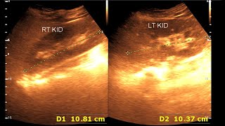 Fatty infiltration of the liver  Kidney Stone [upl. by Aicirt]