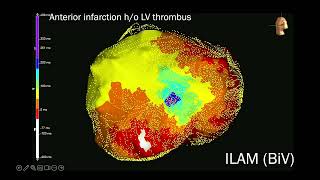 PR2024  Ablation Of Ventricular Arrhythmias 2  April 21 2024 [upl. by Daisey]