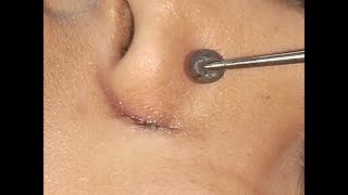 Mole Alar groove of the Nose Excision [upl. by Parks594]