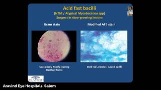 Maximizing the Microbiology Lab for Infectious Keratitis  Dr Ram Rammohan [upl. by Remus]