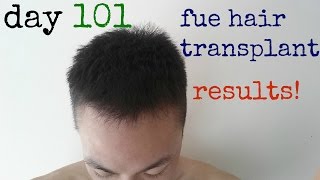 FUE Hair Transplant Surgery  Hair Transplant Before and After  Day 101 [upl. by Acissj869]